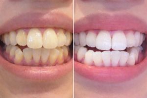 ディノベート　ホワイトニング